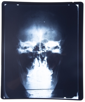 X-Ray of Albert Einsteins Skull